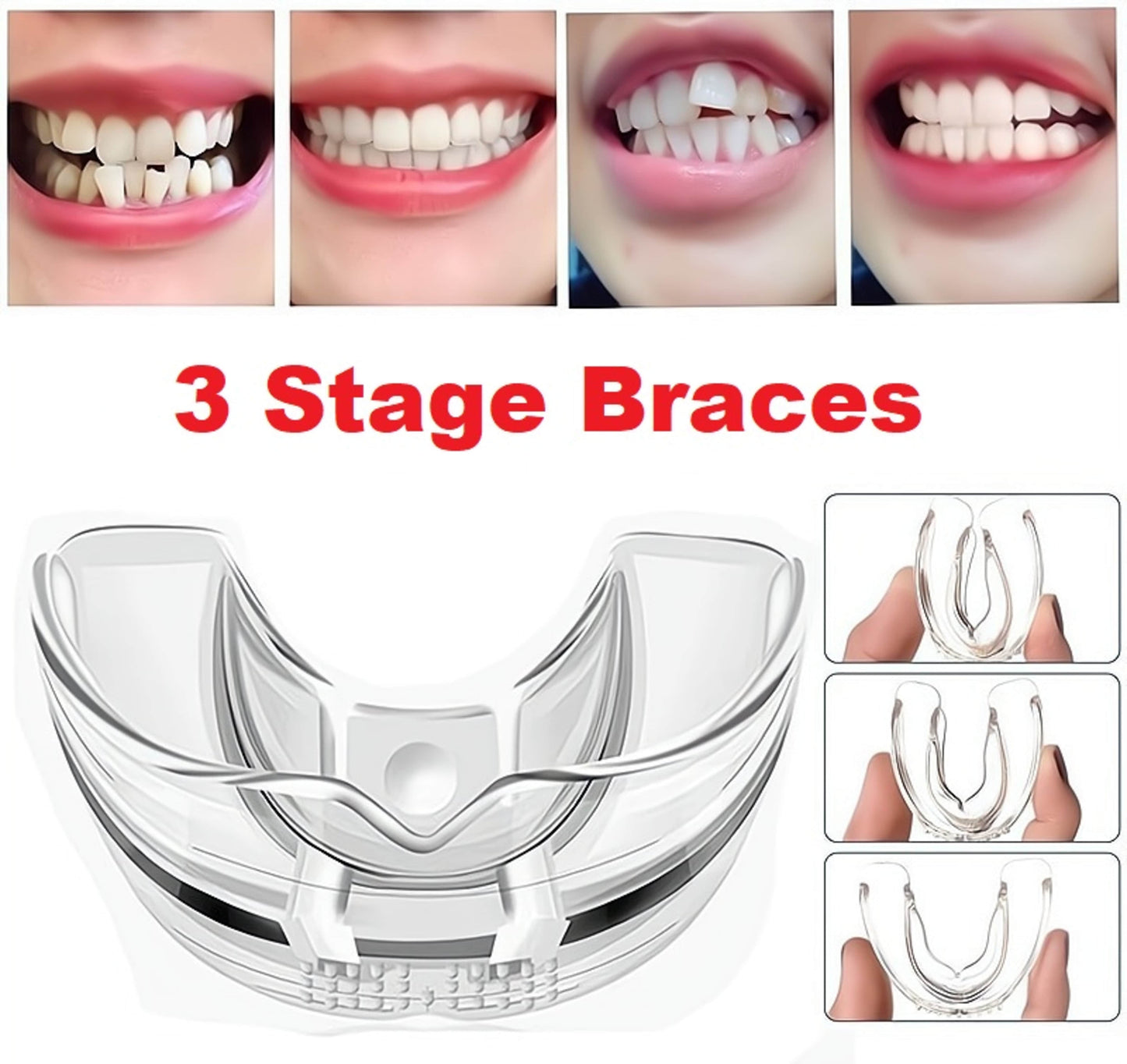 3 Stage Dental Orthodontic Braces